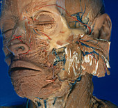 Dissection of Face