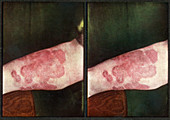 Eczema,Vintage Stereoscopic Image