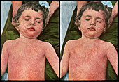 Measles,Vintage Stereoscopic Image