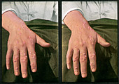 Smallpox,Vintage Stereoscopic Image