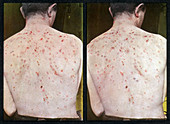 Cystic Acne,Vintage Stereoscopic Image