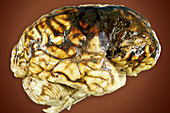 Cerebral Hemorrhage