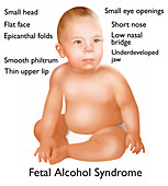Foetal alcohol syndrome baby,artwork