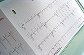 ECG from treadmill stress test