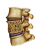 Osteoporosis Fracture in Spine