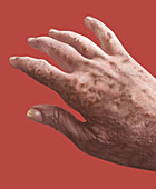 Lentigo or Liver Spots