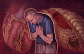 Heart Attack Illustration