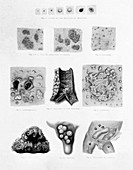 Stages and Types of Smallpox