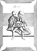 Conjoined Twins,18th Century