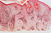 Discoid Lupus Erythematosus,LM