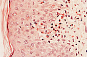 Bullous Pemphigoid,LM