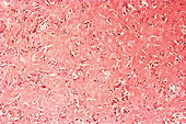 Benign Fibrous Histiocytoma,LM
