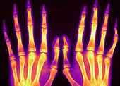 Marfan's Syndrome,X-ray