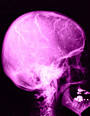 Normal Carotid Angiogram