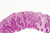 Celiac Disease,LM