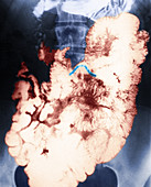 Roundworm,Barium X-ray