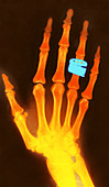Hand with Rings,X-ray