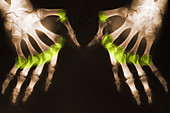 Rheumatoid Arthritis X-Ray