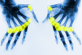 Rheumatoid Arthritis X-Ray