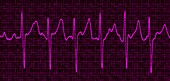 Atrial fibrillation