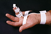 Finger Splint on Patient's Hand