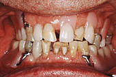 Geriatric Teeth