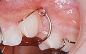 Device to Retract Upper Canine Teeth