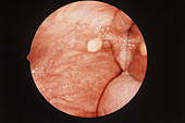Tonsil Cyst