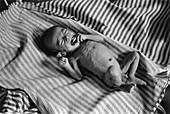 Malnourished Child,Indonesia