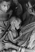 Malnourished Child,Bangladesh