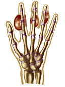 Hand with gout