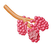 Alveoli Damaged By Emphysema