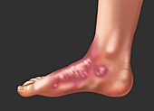 Psoriasis on the Foot