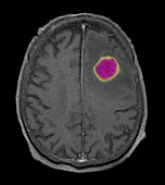 MRI of Abscess in Frontal Lobe