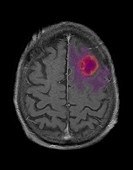 MRI of Abscess in Frontal Lobe