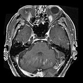 Bell's Palsy (MRI)