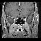 Orbital and Deep Facial Lymphoma (MRI)