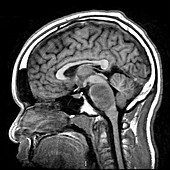 Brainstem Glioma in Child (MRI)