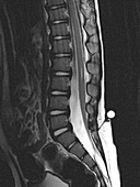 Dermal Sinus and Tethered Cord (MRI)