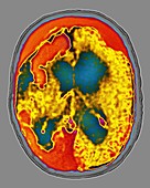 Brain Angioma,MRI