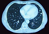 Lung Metastases