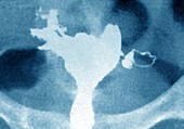 Womb Cancer,X-ray