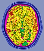 MELAS Syndrome,Brain MRI