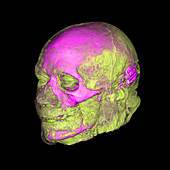 Enhanced 3D CT of Face and Skull