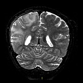 MRI of Rasmussen's Encephalitis