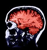 MRI of Normal Brain