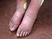 Edema (Swelling) of Ankles and Feet