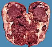 Calcified Hydronephrosis