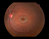 Bull's-Eye Retinopathy