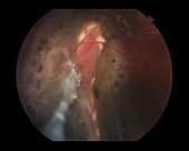 Retinal Detachment